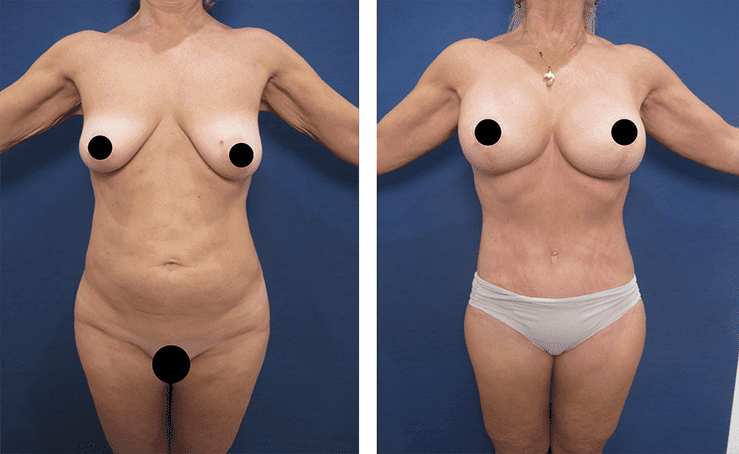 Mini Tummy Tucks in Beverly Hills - See the incredible before and after results! Mini Tummy Tucks in Beverly Hills - See the incredible before and after results!