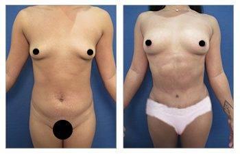 Mommy Makeover To Improve Belly Button Shape Mommy Makeover To Improve Belly Button Shape