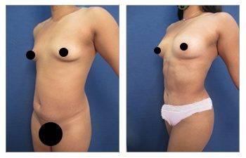 Mommy Makeover To Improve Belly Button Shape Mommy Makeover To Improve Belly Button Shape