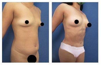 Mommy Makeover To Improve Belly Button Shape Mommy Makeover To Improve Belly Button Shape