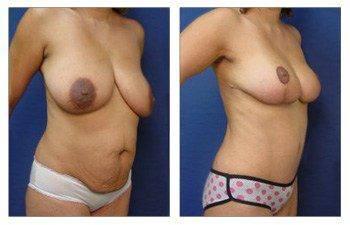 Mommy Makeover With Mini Tummy Tuck And Breast Lift Mommy Makeover With Mini Tummy Tuck And Breast Lift