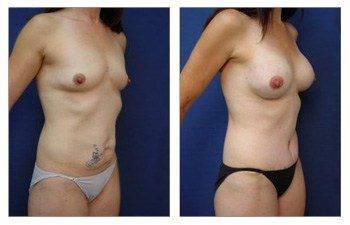 After surgery image of a mommy makeover with a tummy tuck and breast augmentation