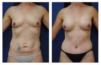 Mommy Makeover + Tummy Tuck + Breast Augmentation — #SS389 Mommy Makeover + Tummy Tuck + Breast Augmentation — #SS389