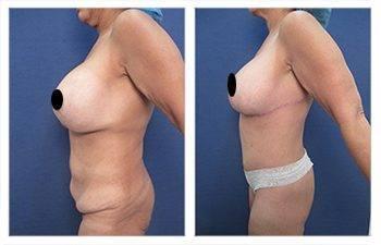 Mommy Makeover With Tummy Tuck And Breast Lift Mommy Makeover With Tummy Tuck And Breast Lift