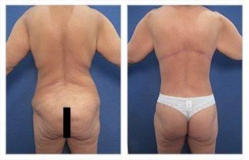 Mommy Makeover With Tummy Tuck And Breast Lift Mommy Makeover With Tummy Tuck And Breast Lift