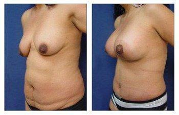 Mommy Makeover With Tummy Tuck And Breast Lift With Implant Augmentation Mommy Makeover With Tummy Tuck And Breast Lift With Implant Augmentation
