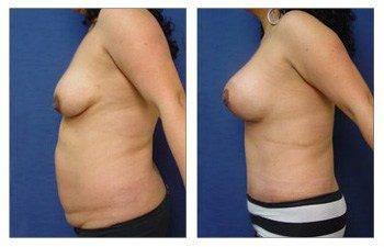 Mommy Makeover With Tummy Tuck And Breast Lift With Implant Augmentation Mommy Makeover With Tummy Tuck And Breast Lift With Implant Augmentation