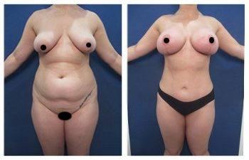 A woman's breast before and after Mommy Makeover surgery, addressing upper belly fullness. A woman's breast before and after Mommy Makeover surgery, addressing upper belly fullness.