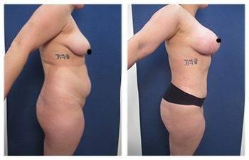 A woman with tattoos showcasing her stunning before and after breast augmentation transformation during Mommy Makeover Specials. A woman with tattoos showcasing her stunning before and after breast augmentation transformation during Mommy Makeover Specials.