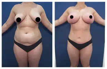 A woman's breast before and after Mommy Makeover surgery, addressing upper belly fullness. A woman's breast before and after Mommy Makeover surgery, addressing upper belly fullness.
