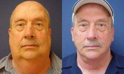 Face lift and neck Face lift and neck