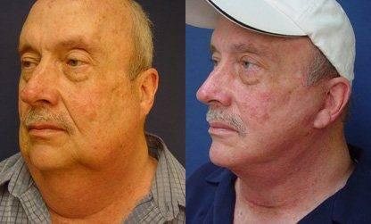 Neck Lift Incisions Neck Lift Incisions