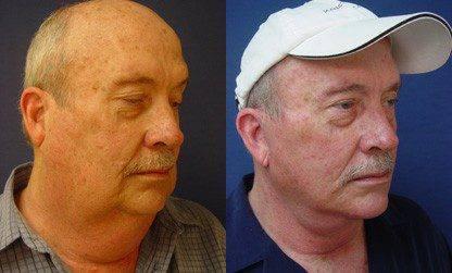 Neck Lift Incisions Neck Lift Incisions