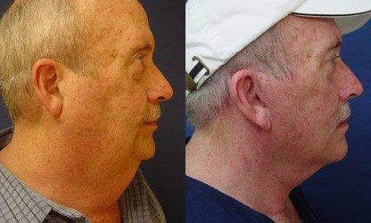 necklift procedure necklift procedure