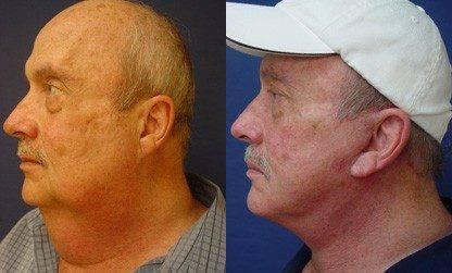 Neck Lift Incisions Neck Lift Incisions