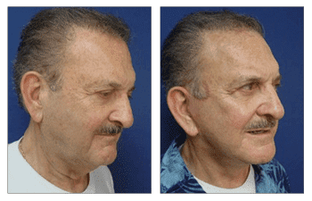 Skin tightening San Diego Skin tightening San Diego