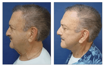 Skin tightening Laguna Beach Skin tightening Laguna Beach