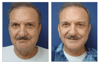 Face Lift and Neck Face Lift and Neck