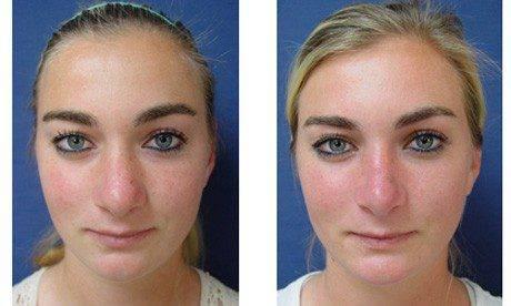 Septoplasty Septoplasty