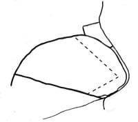 Septoplasty Septoplasty