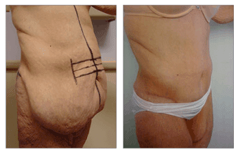 After Gastric Bypass Surgery-Plastic Surgery After Gastric Bypass Surgery-Plastic Surgery