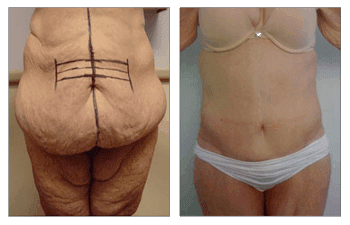 After Gastric Bypass Surgery-Plastic Surgery After Gastric Bypass Surgery-Plastic Surgery