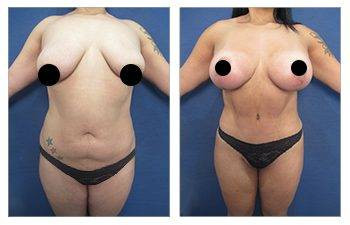 Tummy Tuck + HD Liposuction — #SS016 Tummy Tuck + HD Liposuction — #SS016