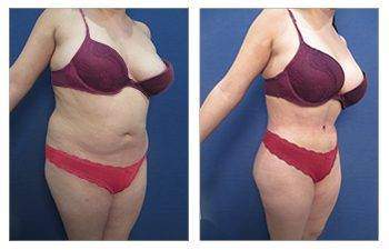 Body Contouring — #SS030 Body Contouring — #SS030