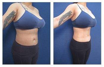 HD Lipo 360 — #SS014 HD Lipo 360 — #SS014