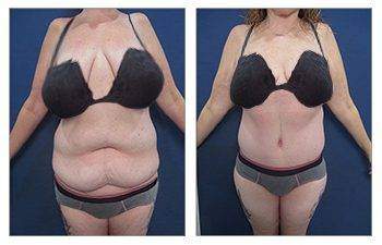 Tummy Tuck — #SS109 Tummy Tuck — #SS109