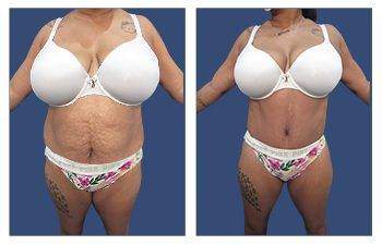 Body Contouring — #SS055 Body Contouring — #SS055