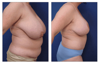 Post-Bariatric Body Cost-SurgiSculpt Post-Bariatric Body Cost-SurgiSculpt