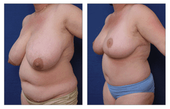 A woman's breasts before and after a breast lift. A woman's breasts before and after a breast lift.