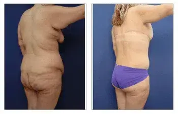 Tummy tuck before and after - How Painful is Post Bariatric Body Lift? Tummy tuck before and after - How Painful is Post Bariatric Body Lift?