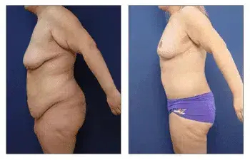 Tummy tuck before and after. Learn about the pain level of post-bariatric body lift. Tummy tuck before and after. Learn about the pain level of post-bariatric body lift.