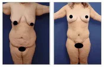 Post Bariatric Body Lift before and after tummy tuck. Post Bariatric Body Lift before and after tummy tuck.