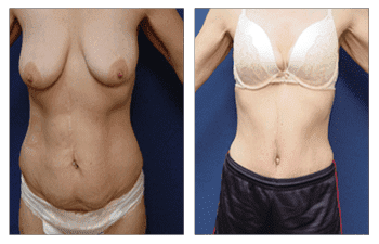 Post Bariatric Body Transformation - Tummy Tuck Before and After Post Bariatric Body Transformation - Tummy Tuck Before and After
