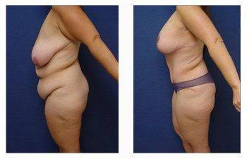 post bariatric surgery diet left view post bariatric surgery diet left view