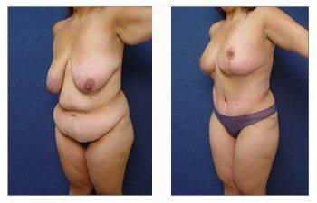 post bariatric surgery patient 14 front left view post bariatric surgery patient 14 front left view
