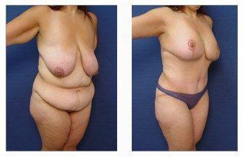 post bariatric surgery patient 14 front right view post bariatric surgery patient 14 front right view