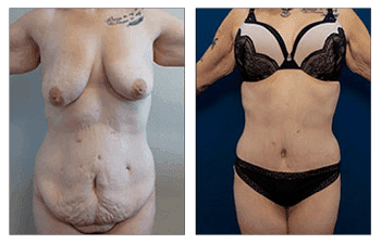 Tummy Tuck