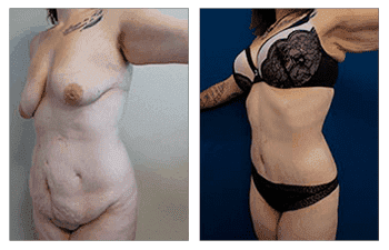 Tummy Tuck
