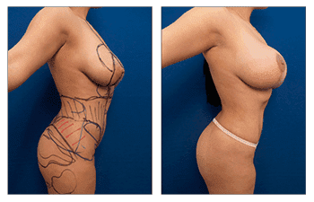 Power Assisted Liposuction Power Assisted Liposuction