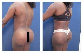 Proper Buttock Implant Placement Proper Buttock Implant Placement
