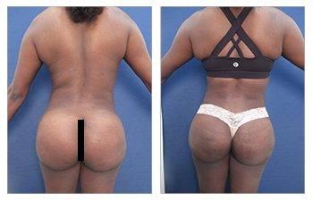 Proper Buttock Implant Placement Proper Buttock Implant Placement
