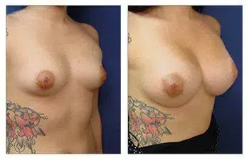 A woman's breast before and after Rapid Recovery Breast Augmentation surgery. A woman's breast before and after Rapid Recovery Breast Augmentation surgery.