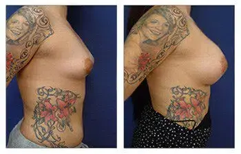 A woman with tattoos on her torso showcasing the transformative results of Rapid Recovery Breast Augmentation. A woman with tattoos on her torso showcasing the transformative results of Rapid Recovery Breast Augmentation.