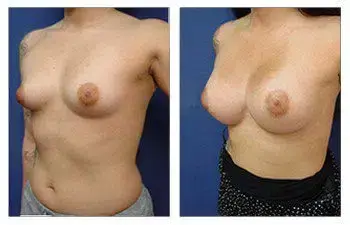 A woman's breast before and after Rapid Recovery Breast Augmentation surgery. A woman's breast before and after Rapid Recovery Breast Augmentation surgery.