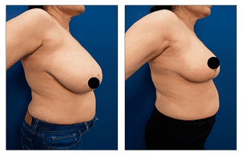 A woman's breast before and after Breast Augmentation surgery.