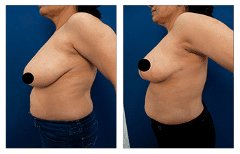 A woman's breast before and after Breast Augmentation surgery.